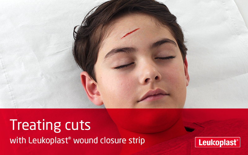 The video shows how cut wounds can be closed using wound closure strips: we see an HCP treating a cut on a boy's forehead with the help of Leukoplast wound closure strip. The video shows how cut wounds can be closed using wound closure strips: we see an HCP treating a cut on a boy's forehead with the help of Leukoplast wound closure strip.